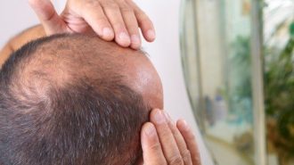 Signs of aging bald head