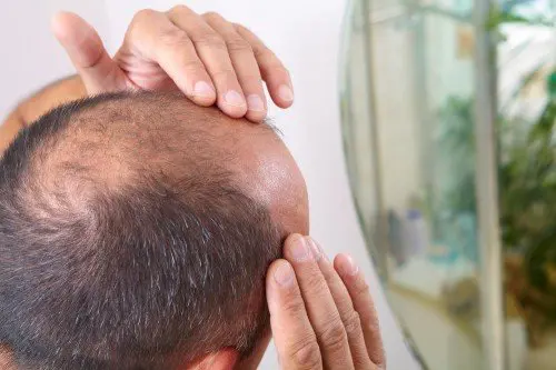 Signs of aging bald head
